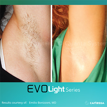 Laser hair removal
